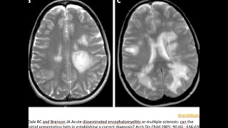 41 ADEM acute disseminated encephalomyelitis demyelination paediatric MOG AB post infectious [upl. by Verla]