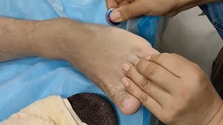 Scraping the athlete’s foot feels so refreshing【Athlete’s foot pedicure】 [upl. by Alhan]