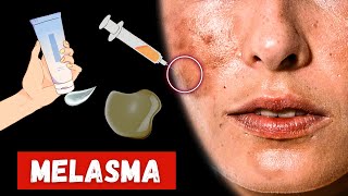 How to Treat Melasma Patches On Your Face [upl. by Atrebla]