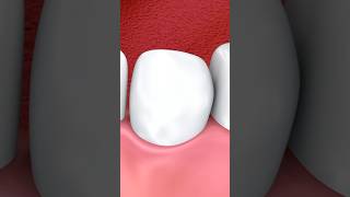 Dental implant surgery dentist usmle neet 3danimation [upl. by Iraam363]