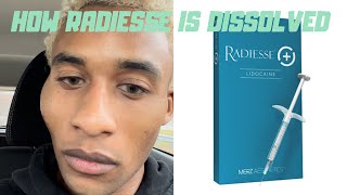 How Radiesse a Permanent Filler is Dissolved [upl. by Bibbye]