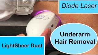 The LightSheer Duet Diode Laser for Underarm Hair Removal [upl. by Sandra]