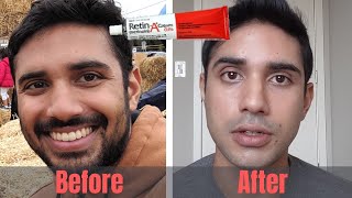 RetinA Tretinoin 6 Month Progress  Tips and Tricks for Starting [upl. by Anatolio]