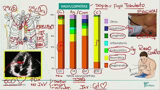 Valvulopatias Estenosis Aortica Insuf Aortica Estenosis Mitral Insuficiencia [upl. by Ikila]