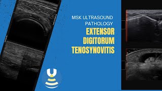 Extensor digitorum tenosynovitis [upl. by Hgielac881]