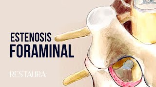 Estenosis Foraminal  ¿Qué significa estrechamiento neuroforaminal [upl. by Esilahc]