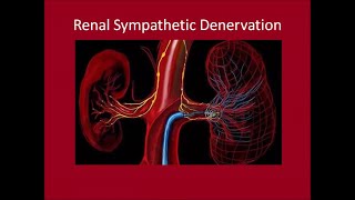 Renal Sympathetic Denervation [upl. by Selrac]