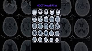 NCCT Head Film [upl. by Howland962]