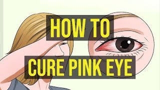 How To Cure Pink Eye Fast  5 Quick Ways [upl. by Alejandra373]