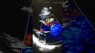 Estenosis Valvular Aòrtica po Ecocardiografia Doppler color Plano Para sete al [upl. by Irmgard]