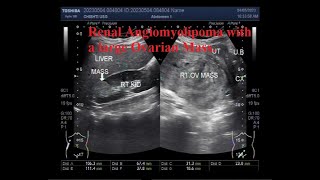 Renal Angiomyolipoma with a large Ovarian Mass [upl. by Ennaecarg]