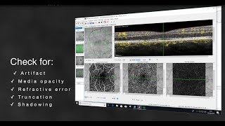 Systematic Interpretation of OCT Angiography Images [upl. by Nielson]