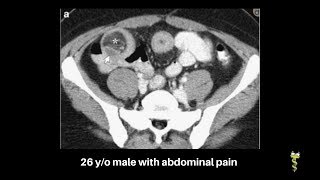 Adult with Meckels diverticulum [upl. by Dde]