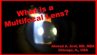 Multifocal Intraocular Lens for Cataract Surgery [upl. by Stephanie70]