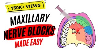 Maxillary Nerve Block Anesthesia For Dental Procedures [upl. by Kreager268]