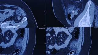 Epiploic appendagitis  CT findings [upl. by Fonsie735]