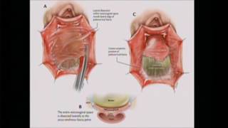 Anatomia de la pelvis y fisiopatologia de los prolapsos órganos pélvicos [upl. by Aihsile140]