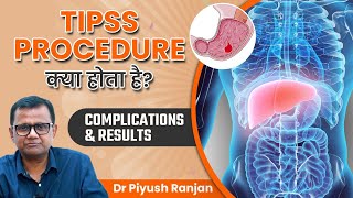 TIPSS Procedure क्या होता है  TIPS Complications and Results  Dr Piyush Ranjan [upl. by Aretse783]