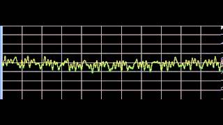 Raynauds Disease  Rife Frequencies [upl. by Rednas]