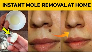 How to Get Rid of Moles on Face Quickly  Natural Home Remedies for Mole Removal at Home [upl. by Aluor]