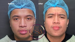 Chin and jawline filler injections for a more masculine look The chiseled Jawline [upl. by Egedan14]