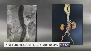 West Michigan man has new procedure to treat aortic aneurysm first in state [upl. by Ahcim]