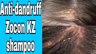 Anti Dandruff shampoo  Zocon kz shampoo review in Hindi  Dandruff shampoo [upl. by Anstus]