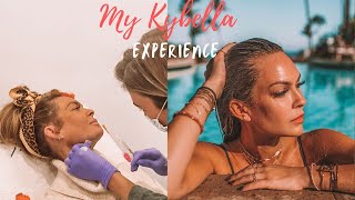 My Kybella experience Before and After 2 kybella treatments [upl. by Anitra]