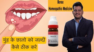 How to Use Borax Homeopathic Medicine for Mouth Ulcer  मुंह के छालों को जल्दी कैसे ठीक करें [upl. by Aronal212]