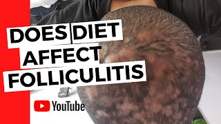 Folliculitis  Does diet affect folliculitis [upl. by Natsirc]