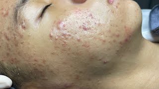 ACNE TREATMENT VU QUYNH MI  Perennial Blackheads On Boy Face 2024FULL [upl. by Pogah183]