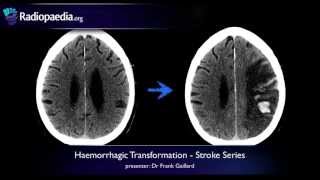 Stroke Haemorrhagic transformation  radiology video tutorial CT MRI [upl. by Blanch418]