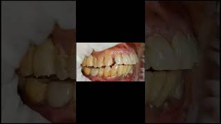 Flat occlusal contour for implant molar crown for generalised attrited dentition shorts [upl. by Targett]