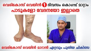 വെരികോസ് വെയിൻ ഒരു ദിവസം കൊണ്ട് മാറ്റാം  Varicose veins malayalam  Dr Muhammed Shareef [upl. by Felise]