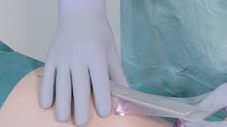 How to apply Mepilex Border PostOp Ag on the knee [upl. by Nhguavaj]