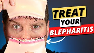 Blepharitis Top 3 Treatments For Blepharitis Removal At Home [upl. by Jecon197]