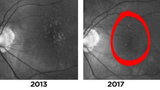 Two Cases of Disappearing Drusen in Patients with AMD [upl. by Lanoil]