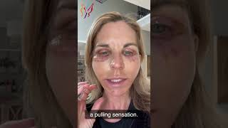 My Advanced Facelift Recovery Day by Day  Real Stories By Real Patients 2022 [upl. by Chan]