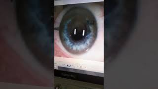 ترسب النحاس داء ويلسونspot diagnosis [upl. by Concettina919]