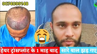 1 Month Completed  Hair Transplant Review [upl. by Kappel]