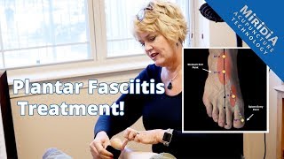 Plantar Fasciitis Pain GONE One Day after Acupuncture [upl. by Ecneret342]