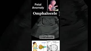 Prenatal Imaging of Omphalocele A Detailed Case Study casestudy anomally shorts DrSaimakhan [upl. by Uela]