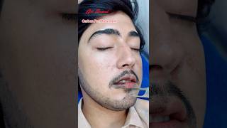 Carbon Peel Laser Treatment getsmarthairclub viralvideo beauty laserhairtreatment laser [upl. by Sana452]