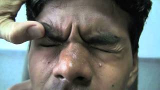 LepClip English 06 Leprosy in Eyes [upl. by Alanna420]