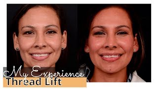 Thread Lift Review My Experience Nova PDO Threads for NonSurgical Facelift [upl. by Spears]