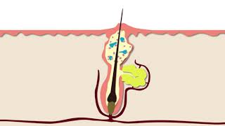 How Acne Develops  Acne Support [upl. by Lacsap904]