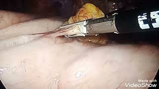 Laparoscopic Nissen fundoplication for Hiatal Hernia with GERD Za Abuja [upl. by Vally]