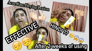 2 WEEKS USING ACNE DRYING LOTION  VLOG5  geminipabrandovlog [upl. by Neron]