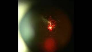 Eye Floater Laser Vitreolysis Patient of Scott Geller MD [upl. by Hurlee240]