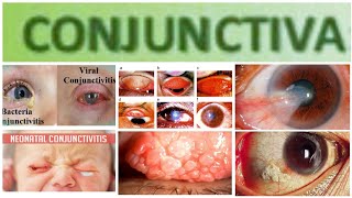 Conjuctiva 3 Major Topic Mucopurulent and Purulent Conjuctivitis [upl. by Haraf90]